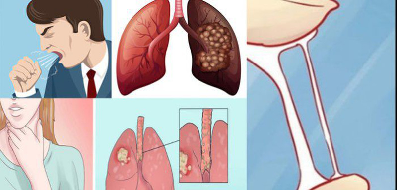 Tất Tần Tật Về Ung Thư Phổi