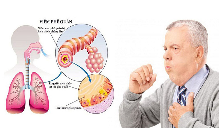 Biến Chứng Nguy Hiểm Từ Viêm Phế Quản Cấp