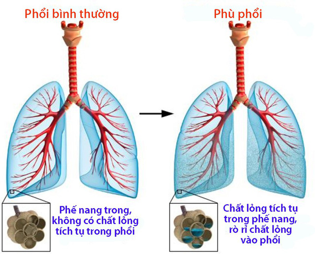 Bệnh Phù Phổi Và Những Thông Tin Cần Biết