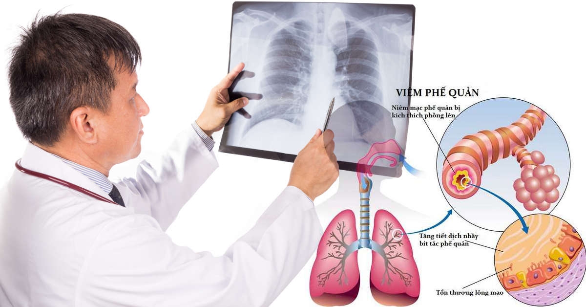 Những Điều Cần Biết Về Viêm Phế Quản Và Cách Điều Trị(CAM)
