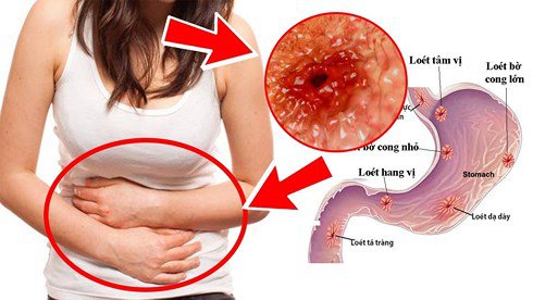 Triệu Chứng Nhận Biết Bệnh Xuất Huyết Tiêu Hóa